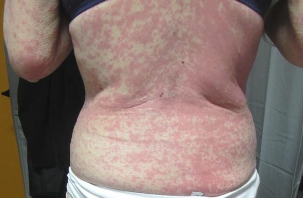 maculopapular-rash-multikinase-inhibitor-skin-toxicity-oncologypro