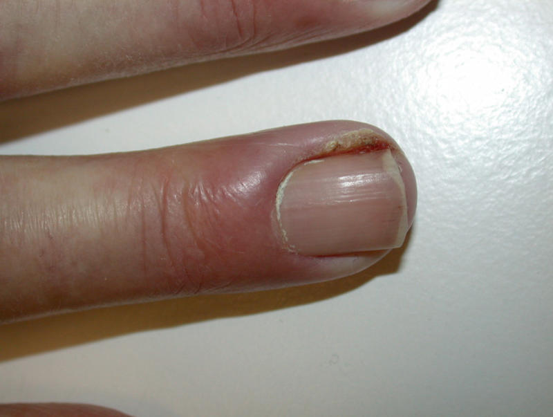 Cellulitis Finger Treatment Fingers-and-toes-of-patient- ...