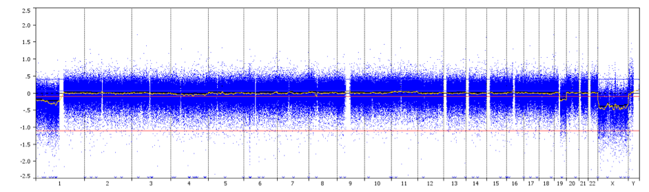 aCGH-profil som visar 1p/19q helarmig co-deletion med centromeriska brytpunkter hos en patient med oligodendrogliom av grad II