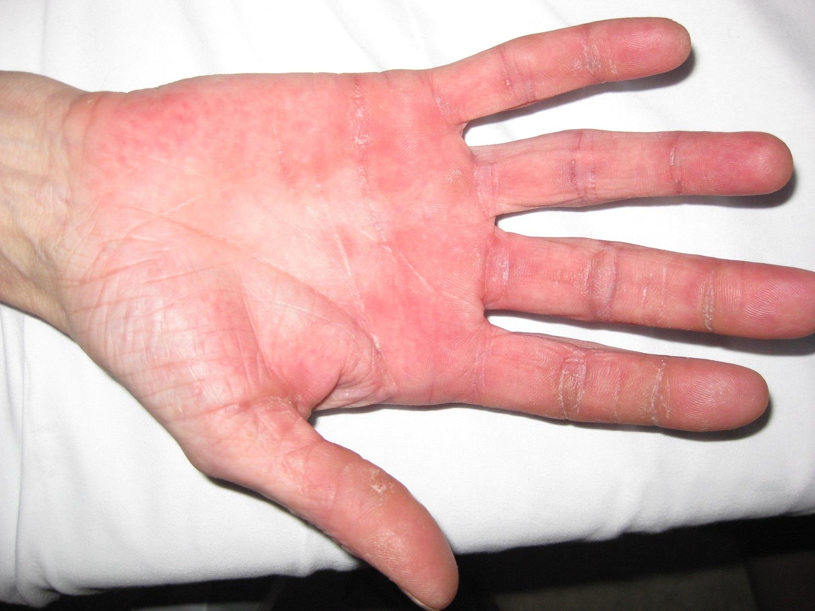 DermNet Case: Widespread Itchy Rash In Patient With Trisomy 21