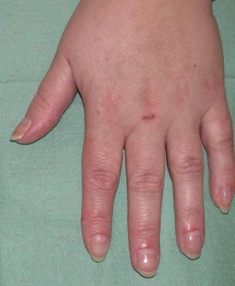 Nail Changes - Paronychia | Multikinase Inhibitor Skin Toxicity
