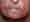 Dettaglio del viso di un paziente affetto da xerosi ed eczema grave durante il trattamento con EGFRI. Immagine resa disponibile per gentile concessione del Prof. Dr. Siegfried Segaert (Ospedale Universitario di Lovanio, Belgio). © 2009 Tutti i diritti riservati.