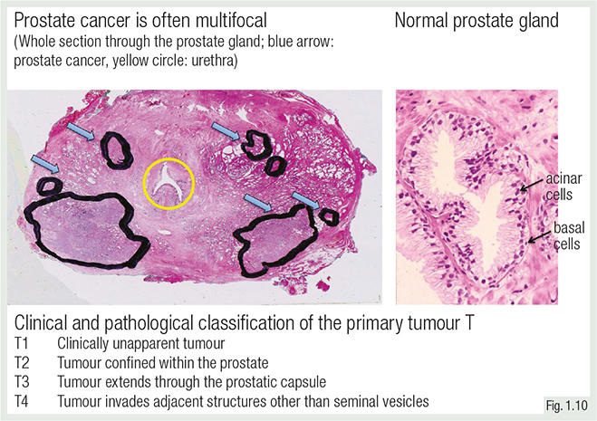 acinar adenocarcinoma prostate histology)