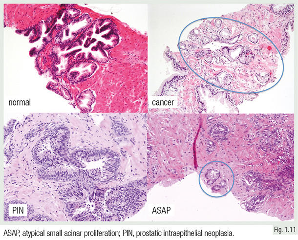 Prostate cancer histology, MeSH terms