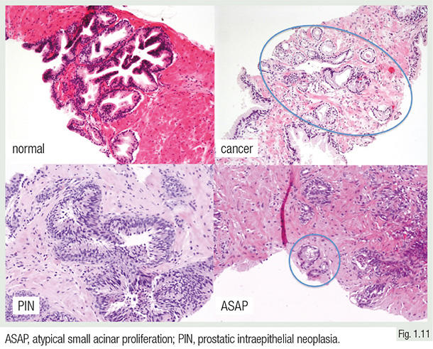 prostatic acinar adenocarcinoma treatment)