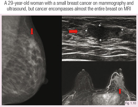 Stage 1 breast cancer